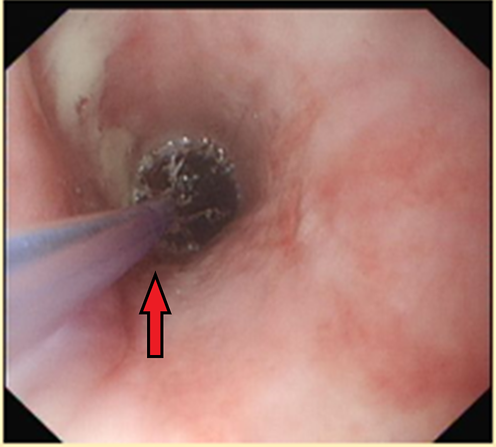 -Endoscopic-dilatation-of-the-benign-oesophageal-stricture-to-12-mm-in-diameter-using-controlled-radial-expansion-(CRE)-wire-guided-balloon-dilatation-catheter