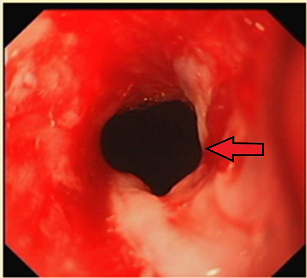 Post-dilatation-appearance-of-the-benign-oesophageal-stricture