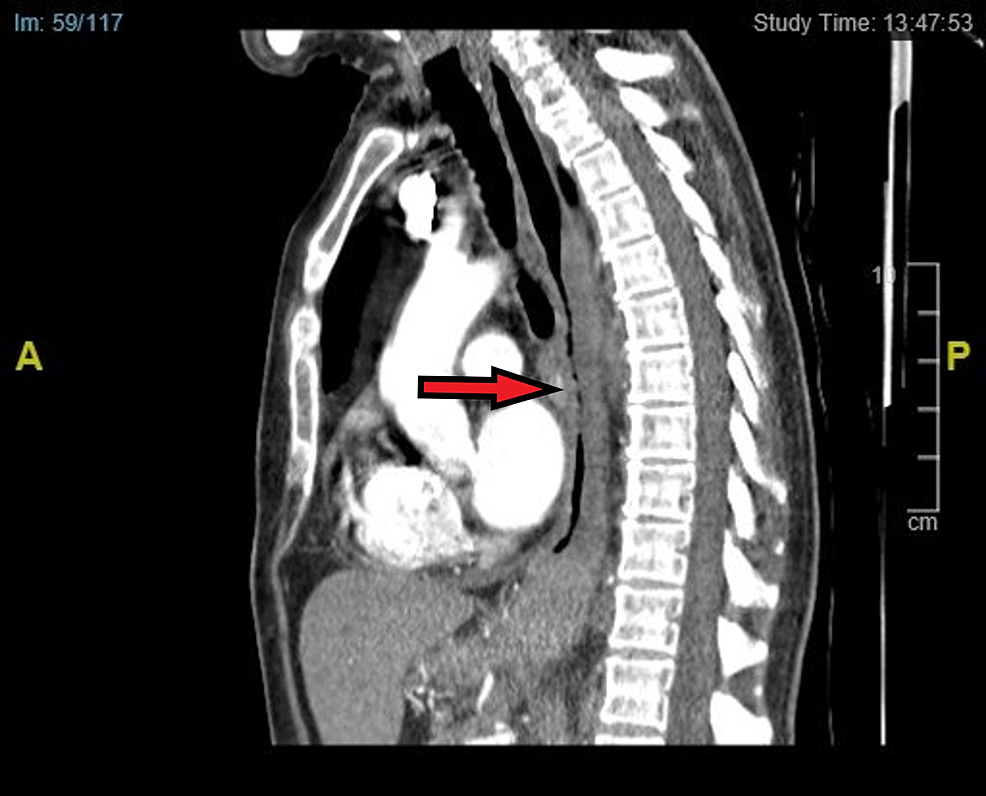 Sagittal-plane-view-of-our-patient’s-CT-thorax-showing-stricturing-oesophagus-from-middle-to-distal-section