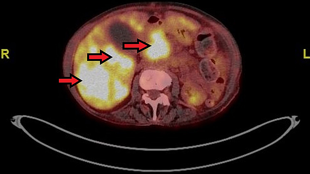 Transverse-plane-view-of-patient’s-Ga68-DOTATATE-PET/CT-scan-demonstrating-multiple-foci-of-intense-increased-tracer-uptake-within-both-lobes-of-the-liver-and-within-the-proximal-pancreas,-signifying-a-metastatic-NET