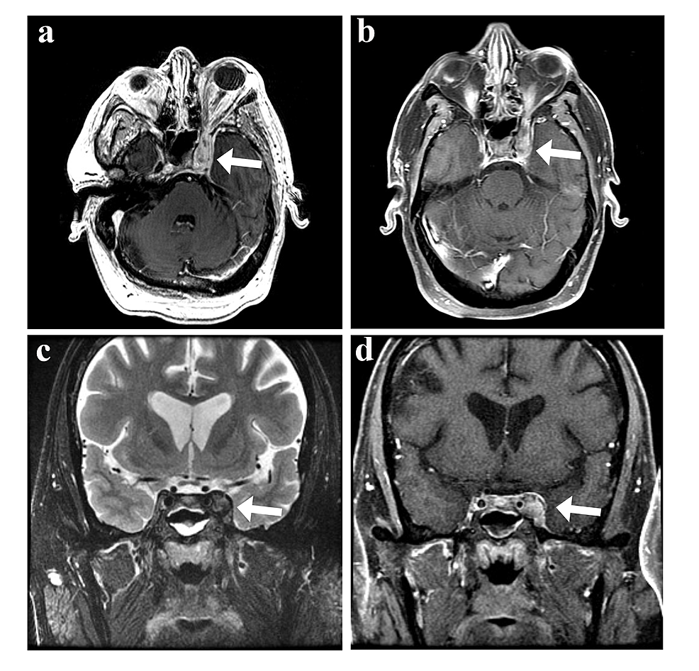 MRI-of-an-inflammatory-left-cavernous-sinus-process-consistent-with-Tolosa-Hunt-syndrome