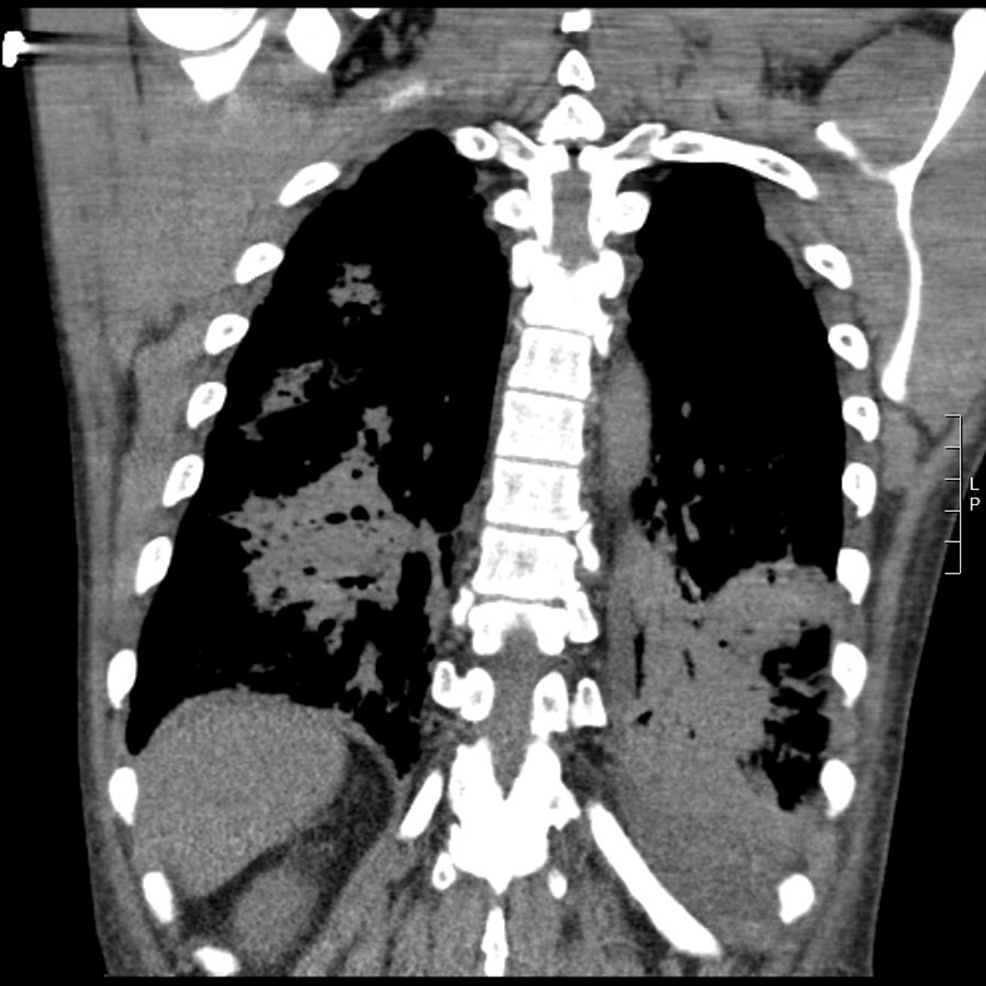 Human Metapneumovirus Pneumonia Precipitating Acute Respiratory