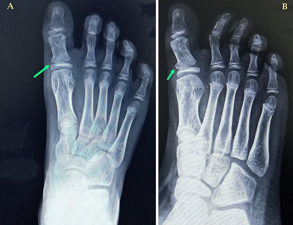 Great Toe Proximal Phalanx Fracture