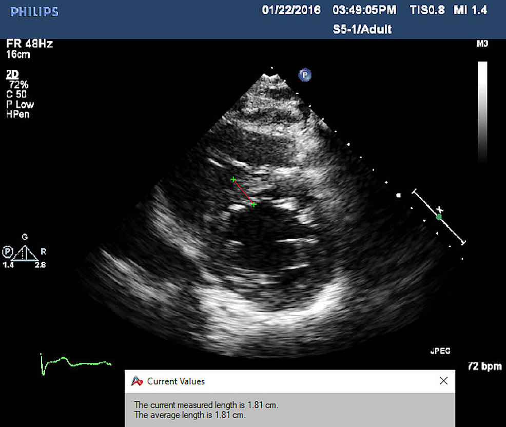 The-parasternal-short-axis-shows-the-concentric-ventricular-hypertrophy