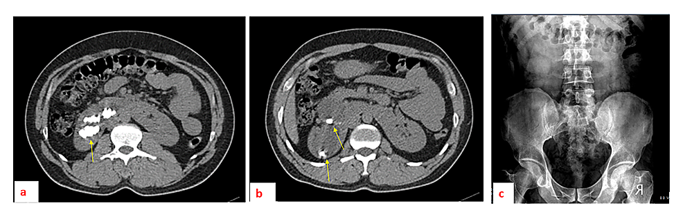 A-patient-with-selected-axial-sections-of-plain-abdominal-CT-demonstrating-multiple-renal-stone-aggregates-(a-and-b)-located-in-the-upper-and-lower-calyceal-groups-in-the-right-kidney-before-the-percutaneous-nephrostomy/nephrolithotomy.-An-abdominal-X-ray-one-month-after-the-procedure-(c),-with-no-residual-stones-seen-in-the-kidney-areas.