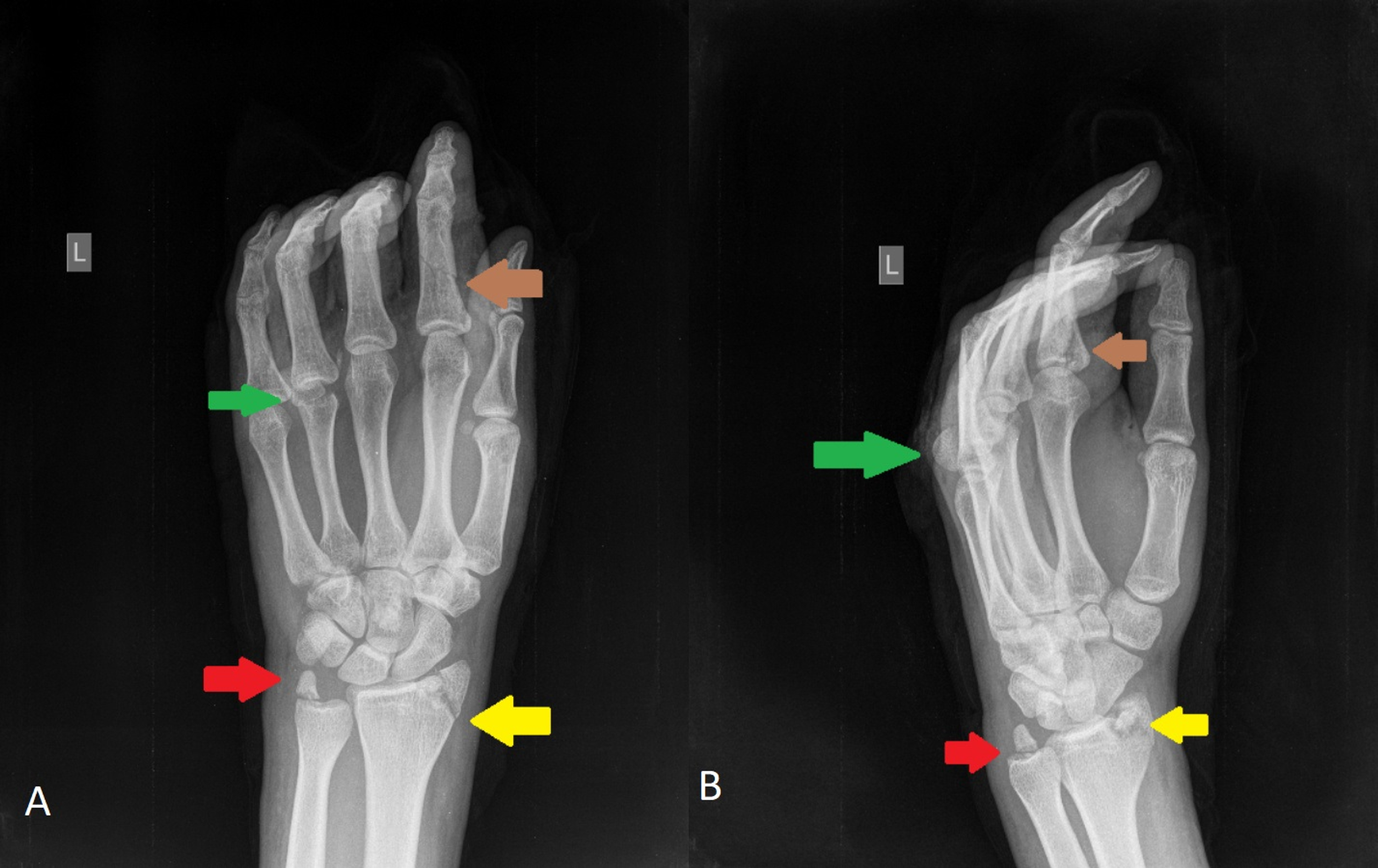 Ulna Hairline Fracture