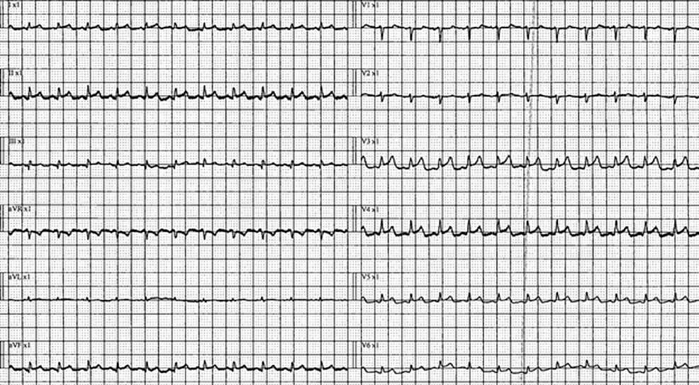ECG-showing-sinus-tachycardia,-short-PR-interval,-T-wave-abnormality-and-diffuse-ST-elevation-across-leads.