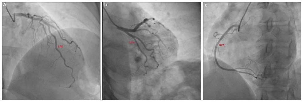 Patient's-coronary-angiogram.
