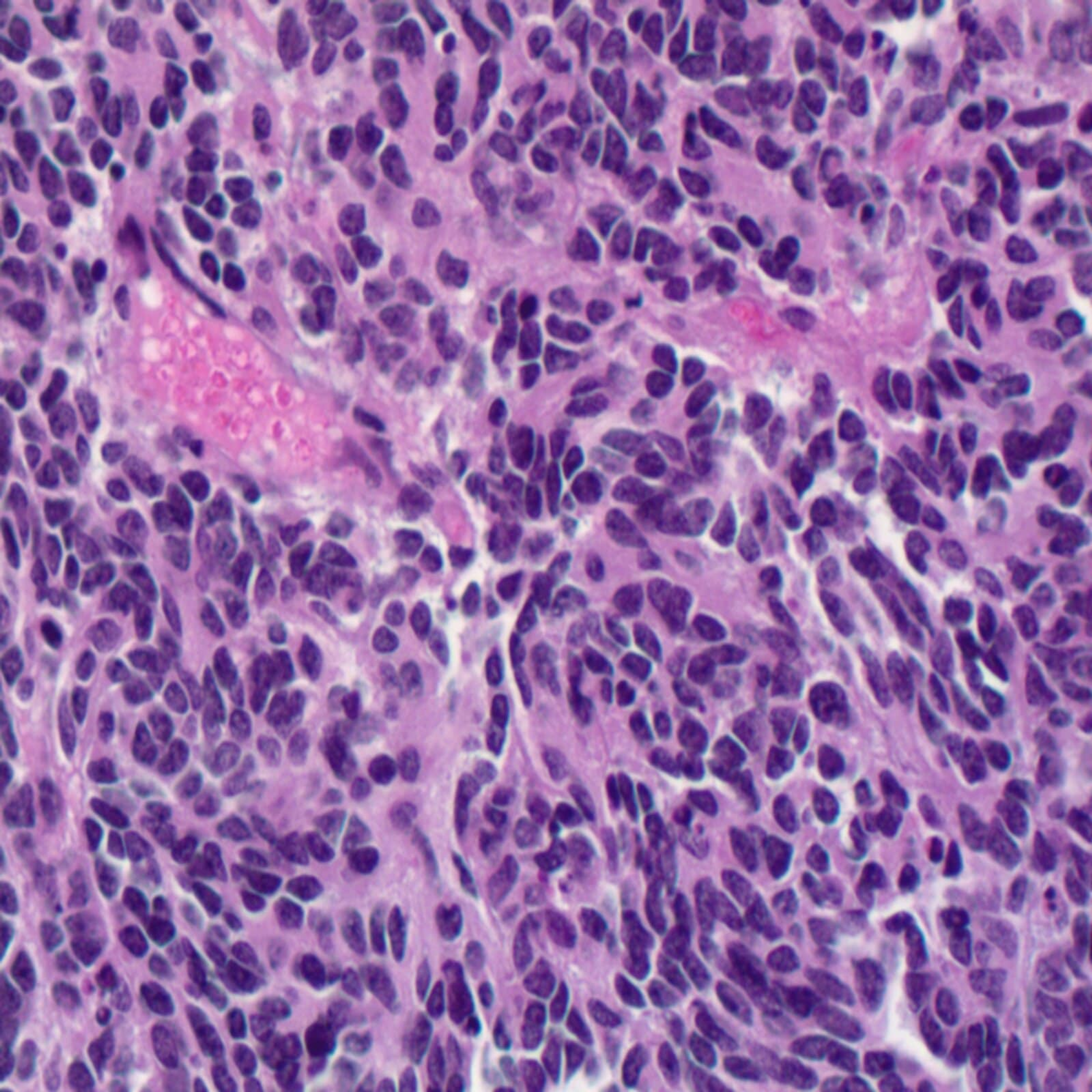 Cureus Medulloblastoma In An Adult Female Patient A Rare Presentation