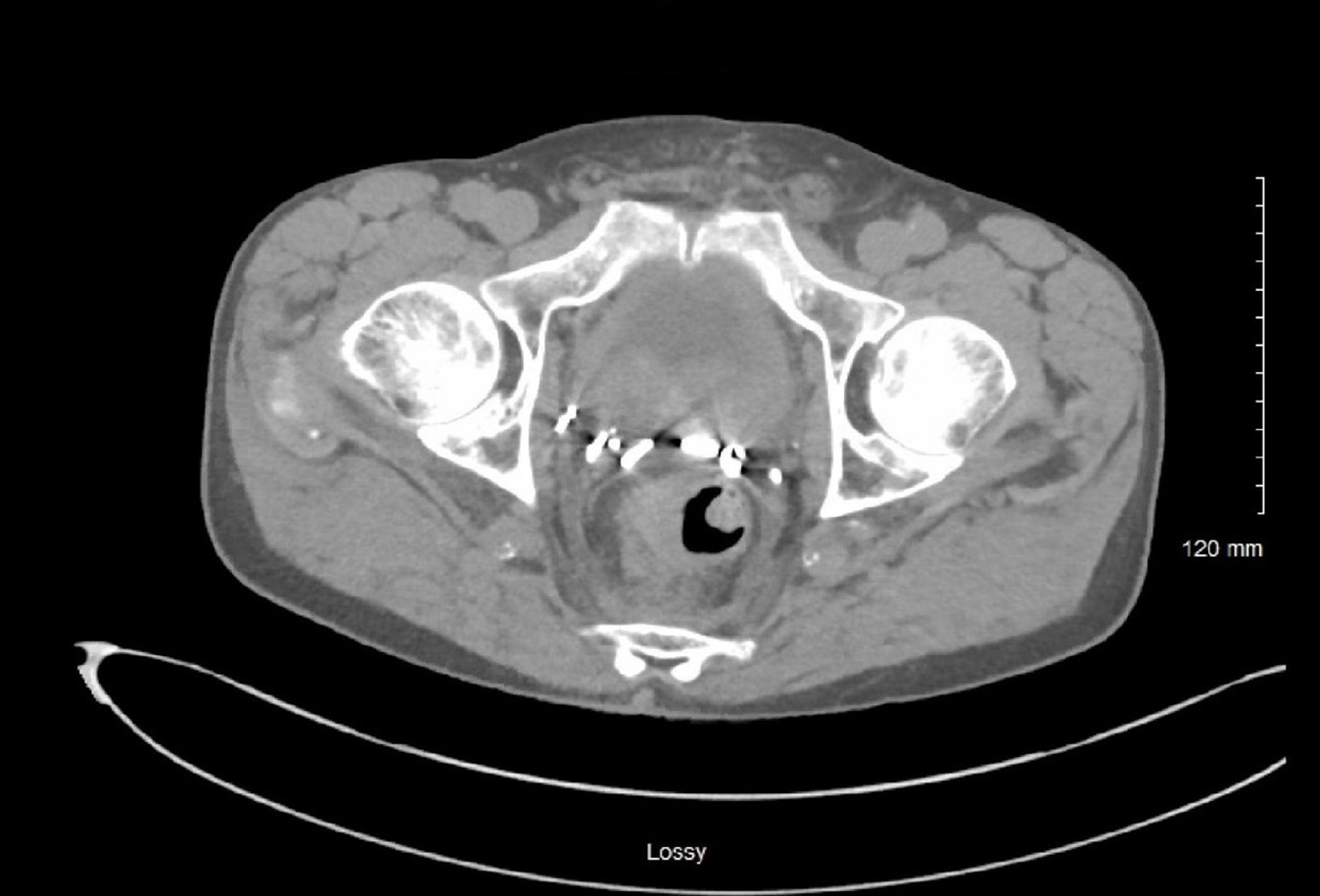 Cureus Tenesmus An Unusual Presentation of Delayed Prostate