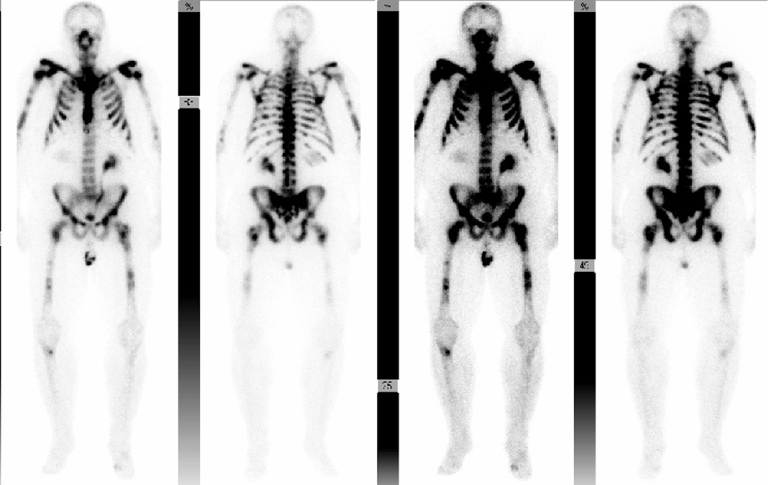 Cureus | Hypocalcemia In A Patient With Metastatic Prostate Cancer From  Denosumab Treatment