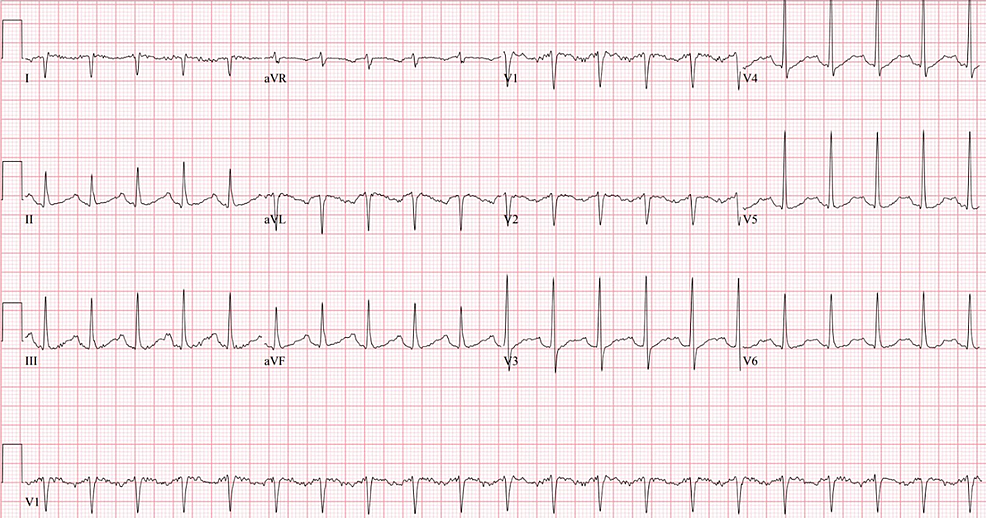 Cureus | Acute Saddle Embolus With Thrombus in Transit: A Case Report ...