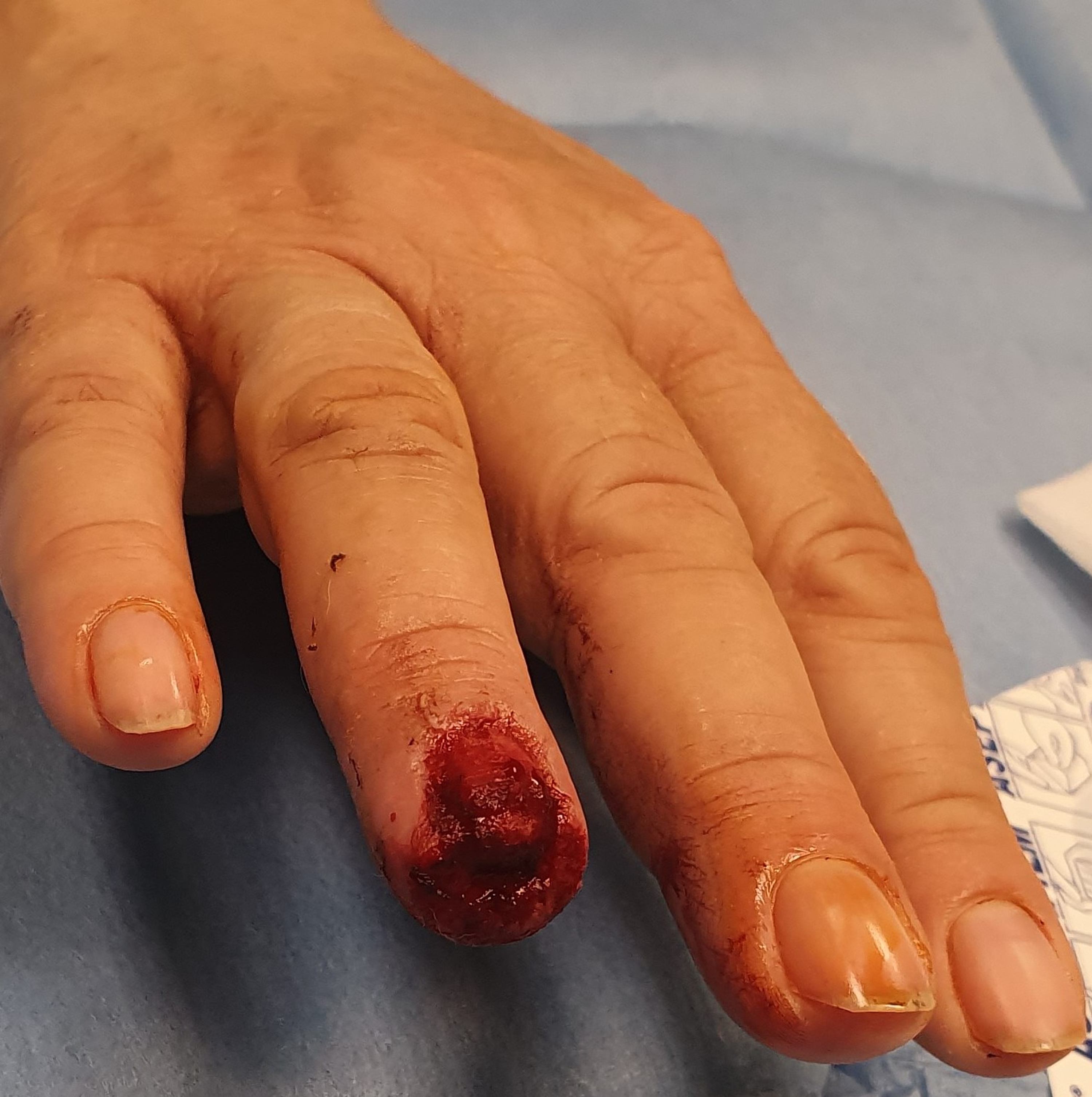 Cureus | Nail Regeneration of an Allen III Fingertip Amputation After a Dog  Bite Using the Semi-occlusive Dressing Technique: A Case Report and  Literature Review | Article