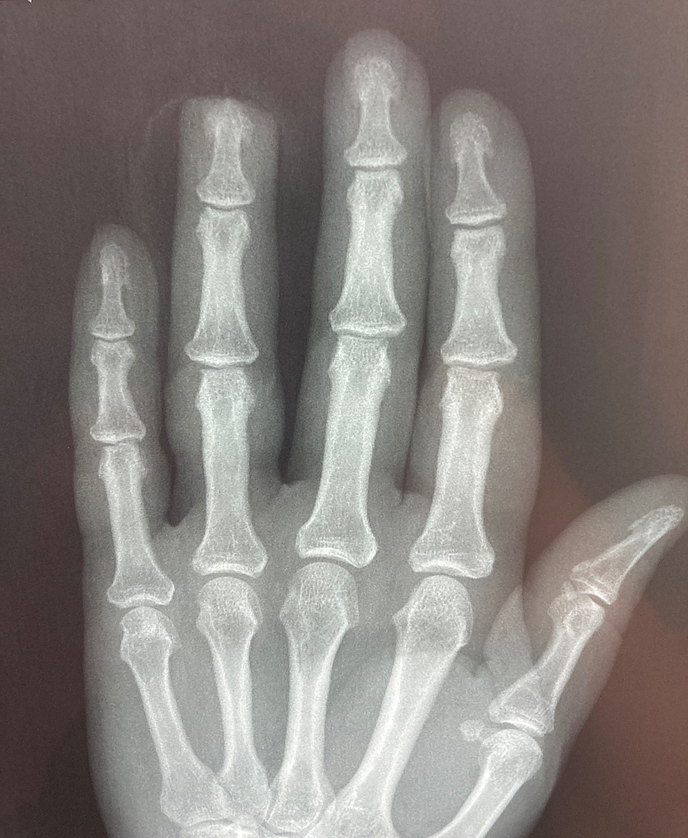 Cureus Nail Regeneration of an Allen III Fingertip Amputation After a