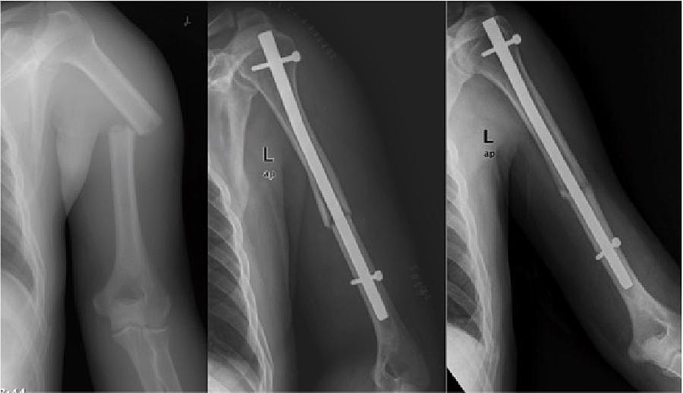 Comparison Of Expandable And Locked Intramedullary Nailing For Humeral ...