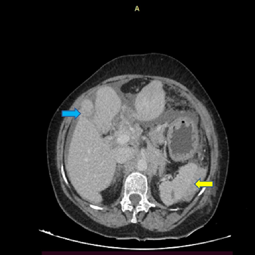 Cureus An Unusual Presentation Of Extra Oral Plasmablastic Lymphoma With Unique Cytomorphology