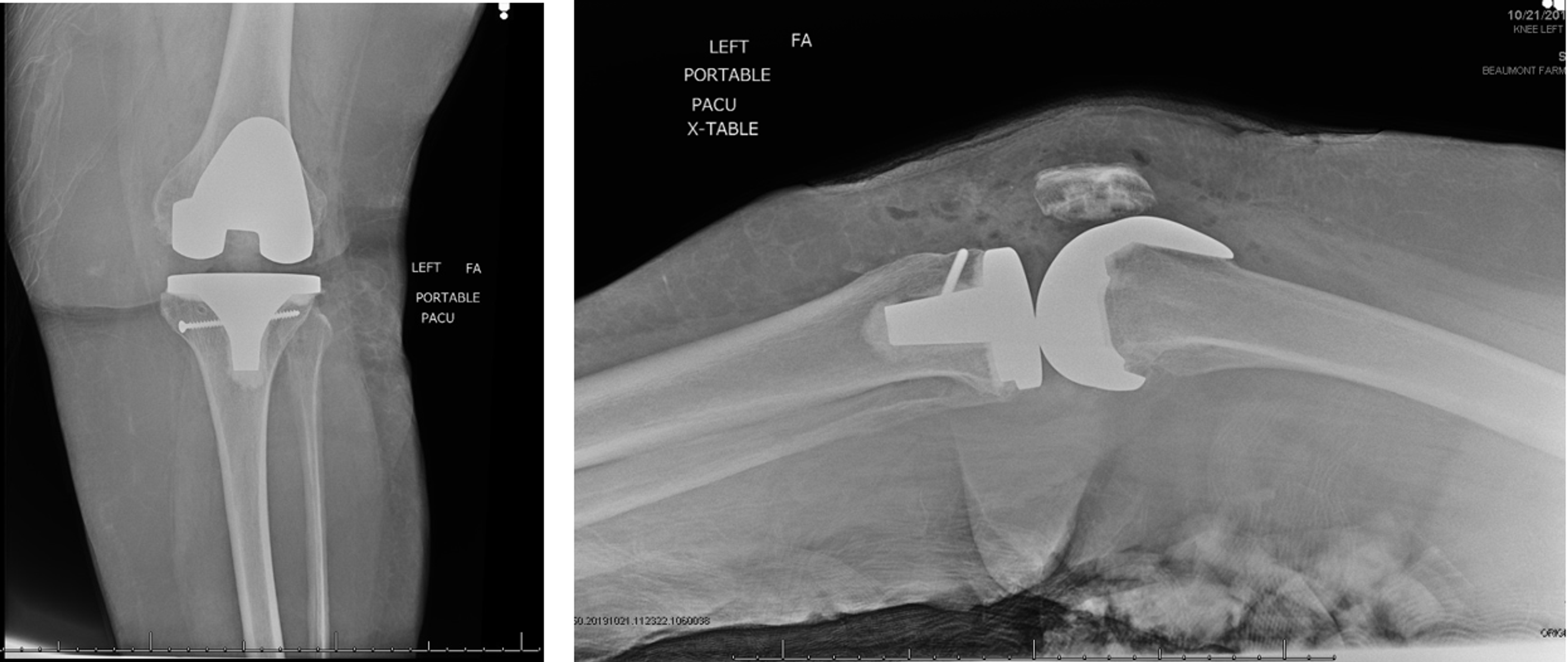 Cureus Intraoperative Tibia Fractures During Primary Total Knee