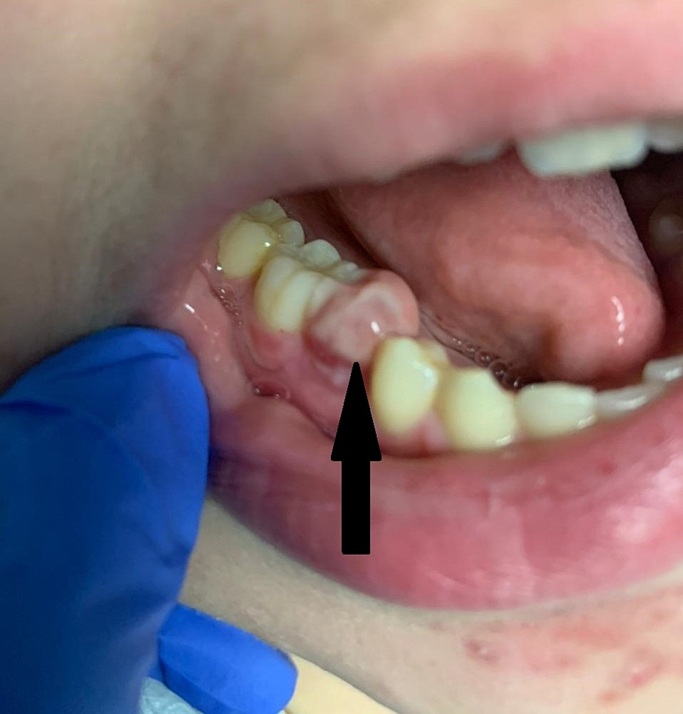 Findings-on-examination-of-oral-cavity-showing-gingival-swelling.