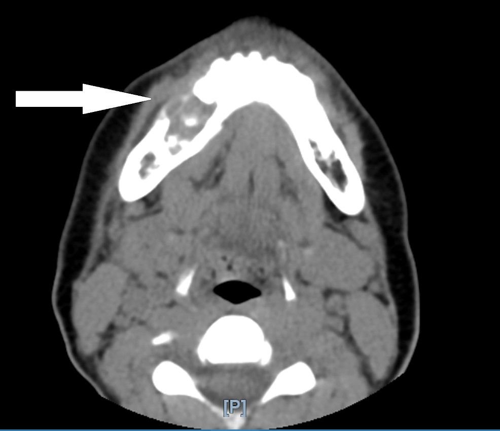 CT-scan-of-the-maxillofacial-area-without-contrast-showing-lytic-lesion-of-the-right-mandible.