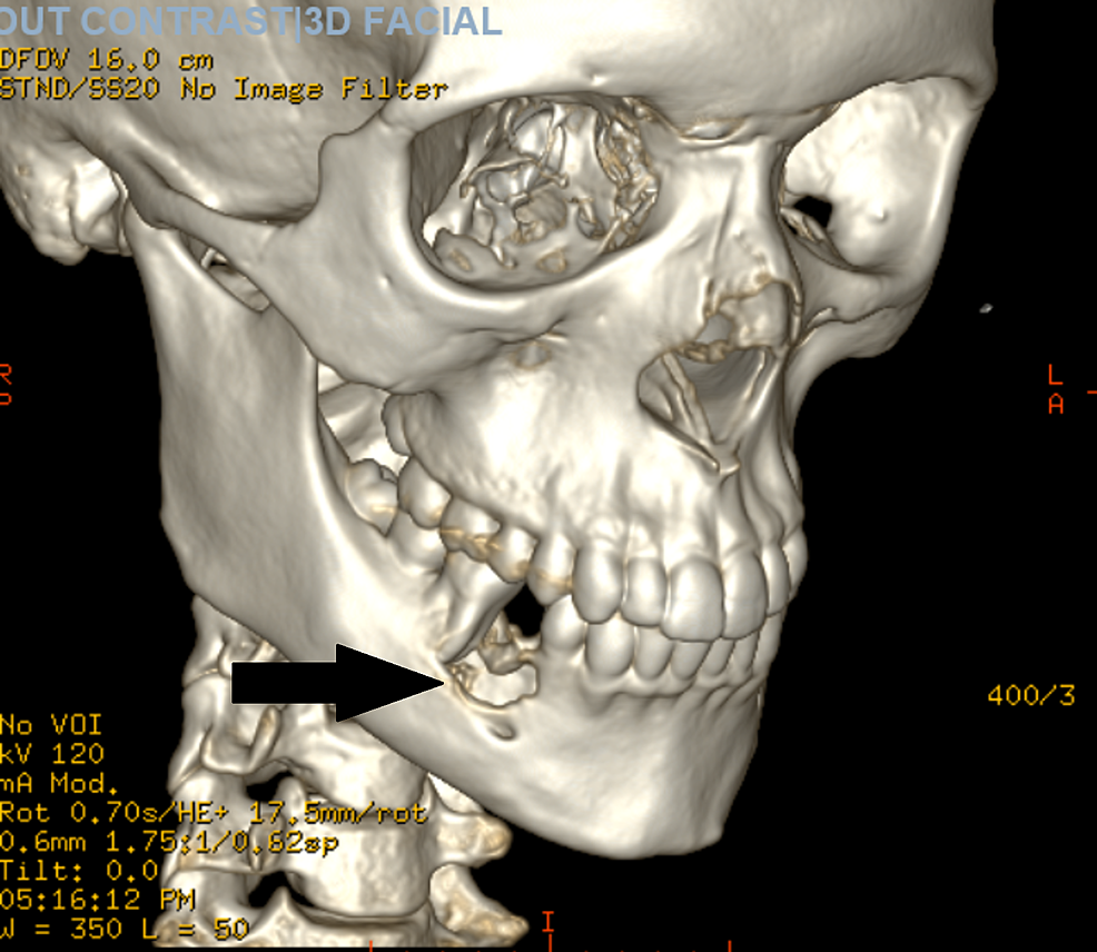 CT-scan-of-the-maxillofacial-area-without-contrast-with-3D-recon-showing-lytic-lesion-of-the-right-mandible.
