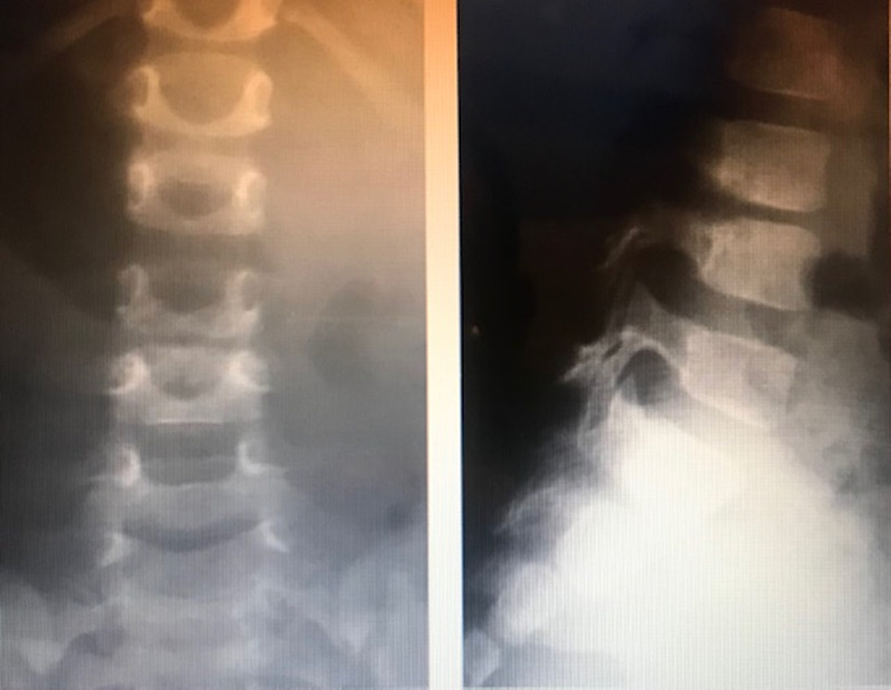 Cureus, Tuberculosis of the Cervical Spine: A Case Report