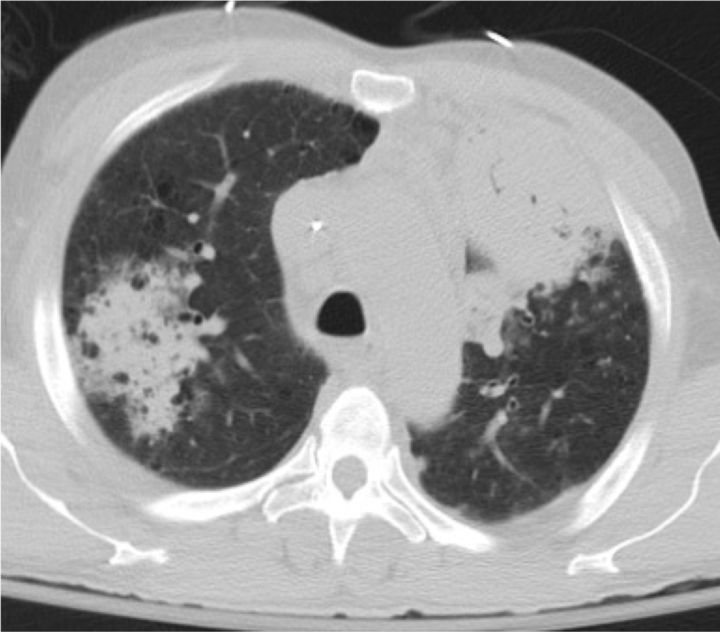 Cureus Human Metapneumovirus Pneumonia Precipitating Acute