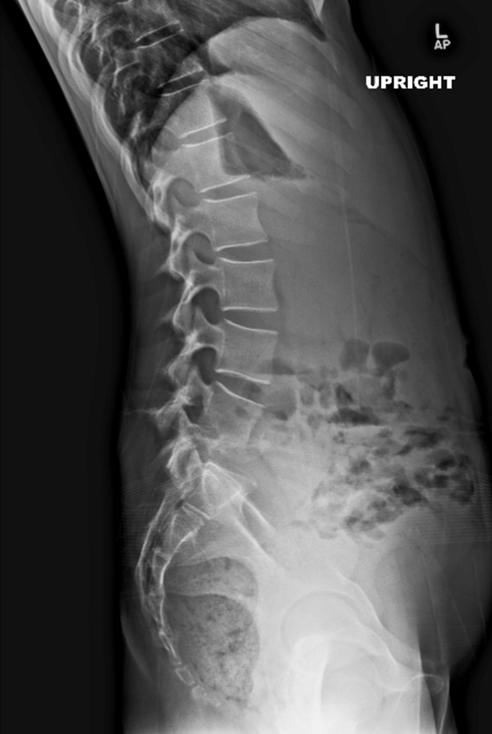Cureus | The Diagnosis and Management of Pediatric Spine Infections