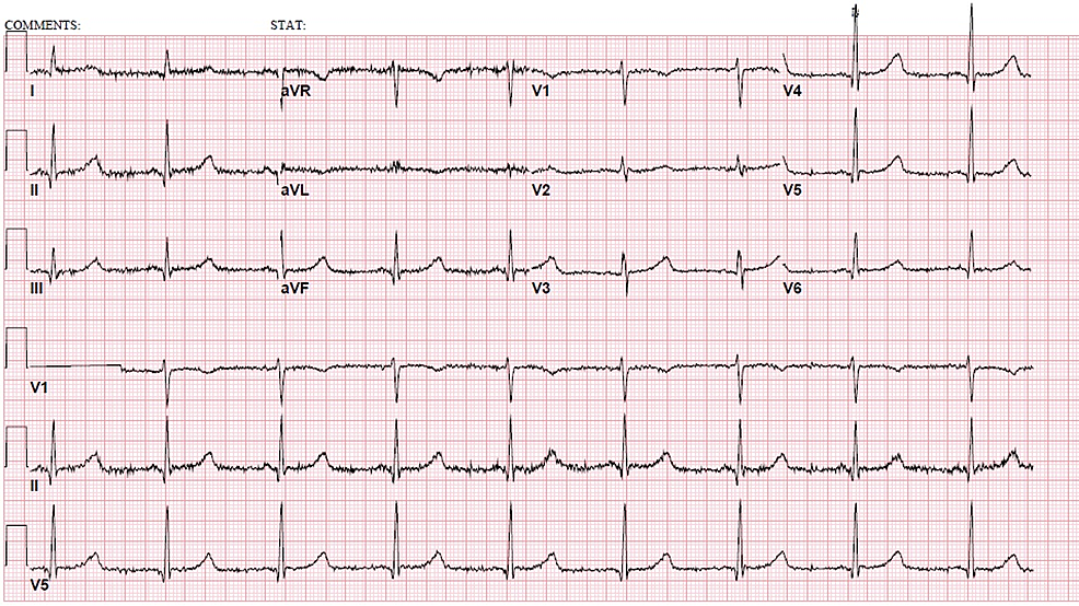 Cureus | Status Epilepticus as a Life-Threatening Manifestation of ...