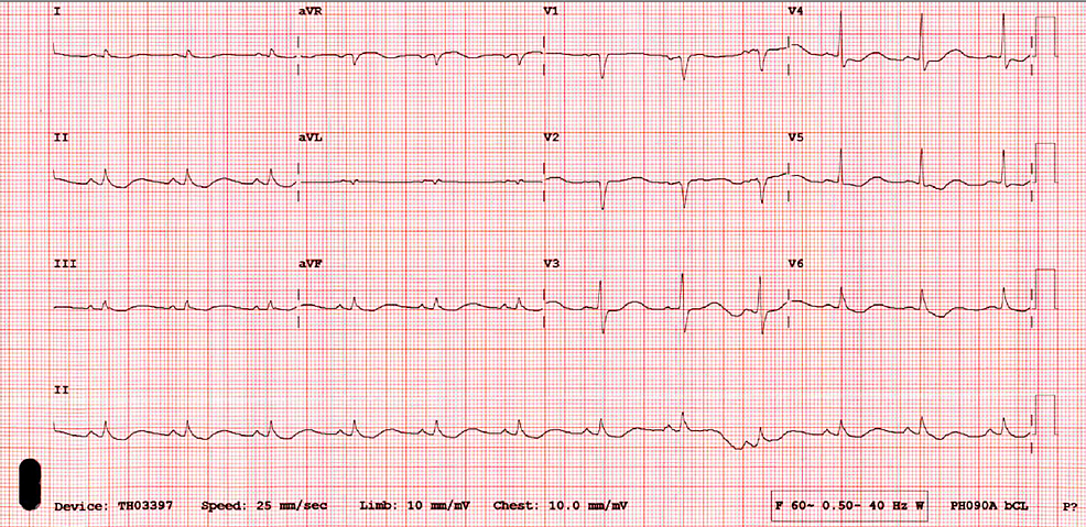 Cureus | Reversible Takotsubo Syndrome Complicated With Acute ...