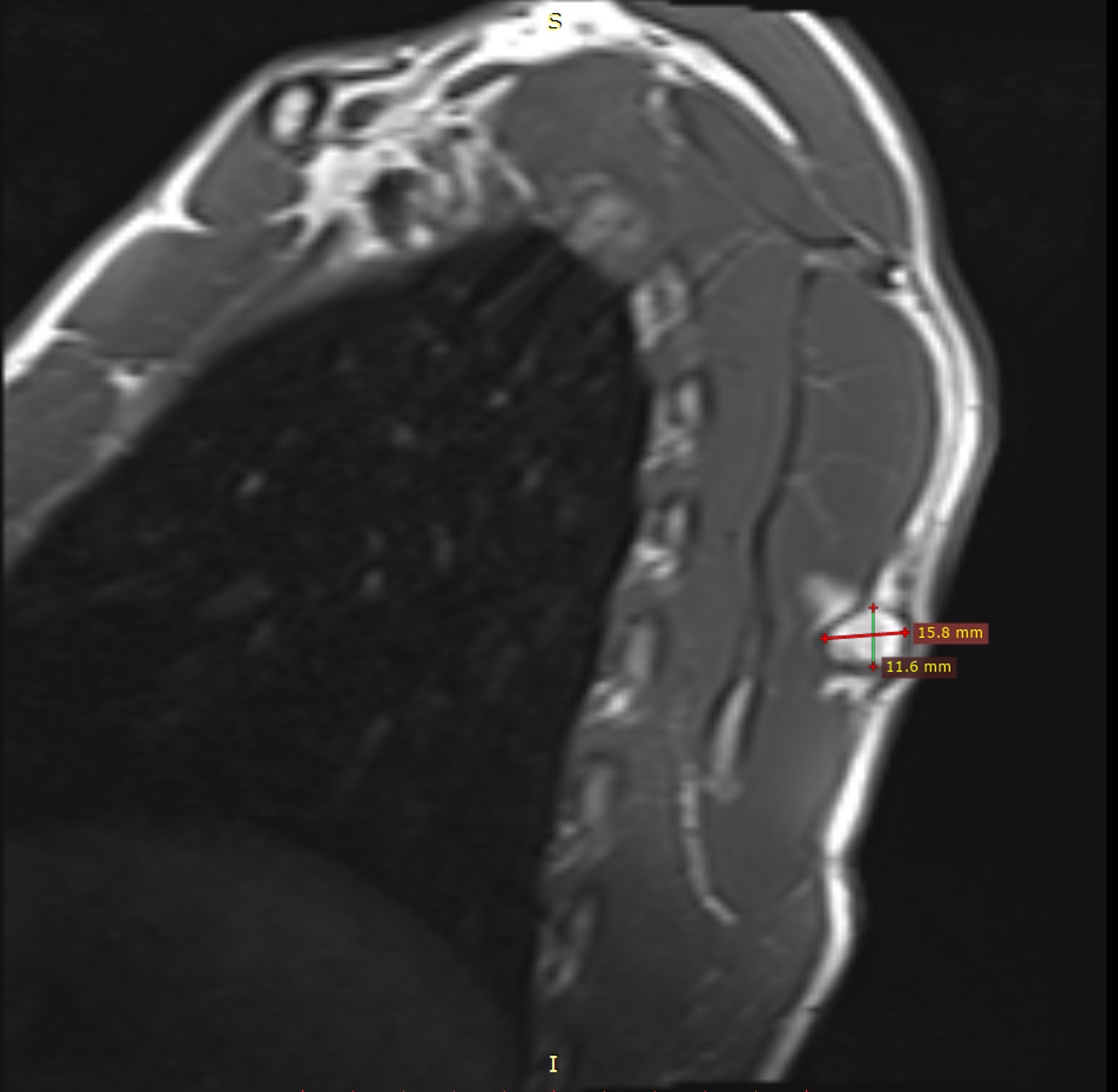 Scapula Anatomy MRI