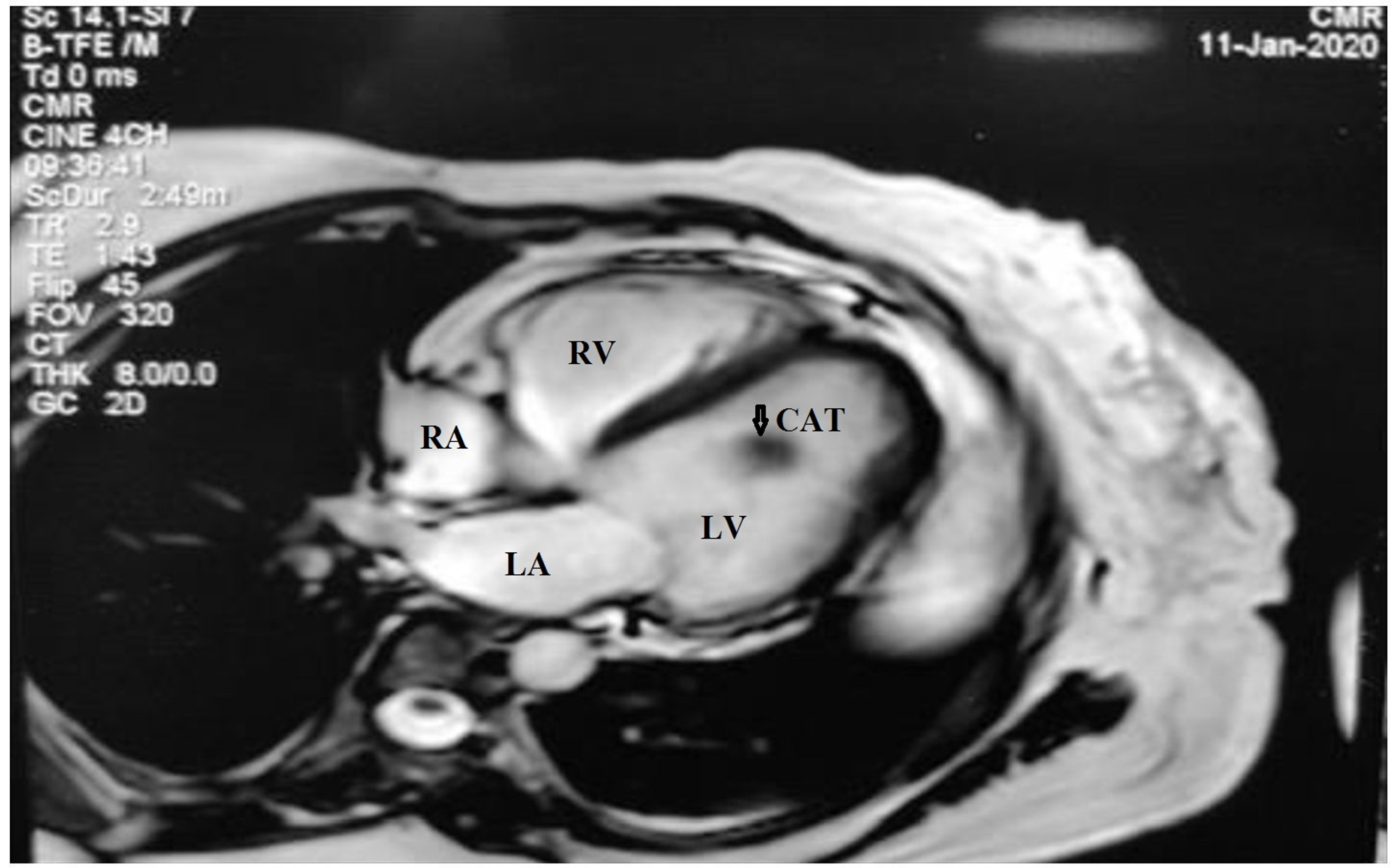 Cureus Calcified Amorphous Tumor Of Left Ventricle A Rare Cardiac Tumor