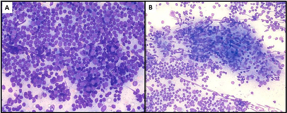 (A)-Highly-cellular-smears-showing-a-polymorphous-population-of-reactive-lymphoid-cells---mature-lymphocytes,-centrocytes,-centroblasts,-immunoblasts-and-plasma-cells-(Leishman-Giemsa-stain,-400x).-(B)-Clusters-of-spindle-shaped-endothelial-cells-mimicking-epithelioid-cell-granulomas,-admixed-with-lymphoid-cells-(Leishman-Giemsa-x-200).