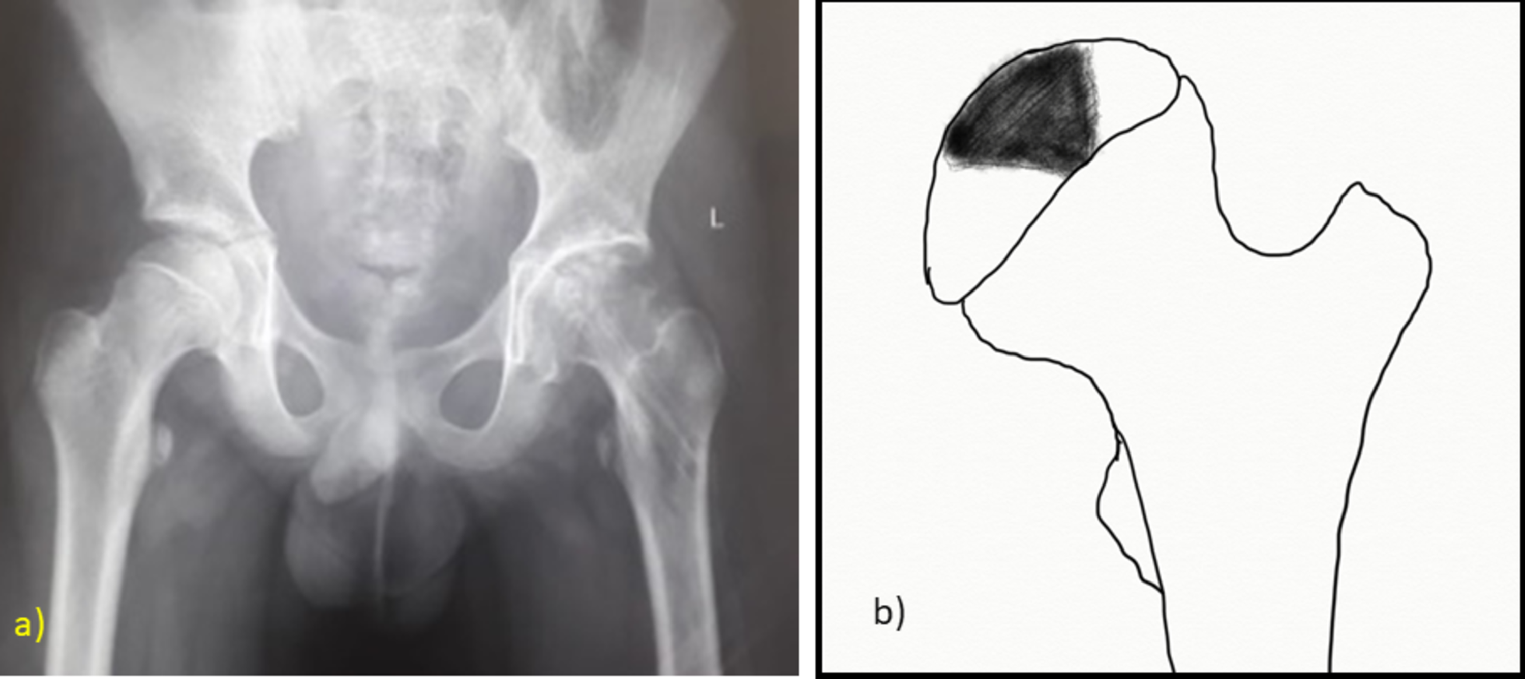 Cureus Risk Factors for Avascular Necrosis of the Femoral Head in