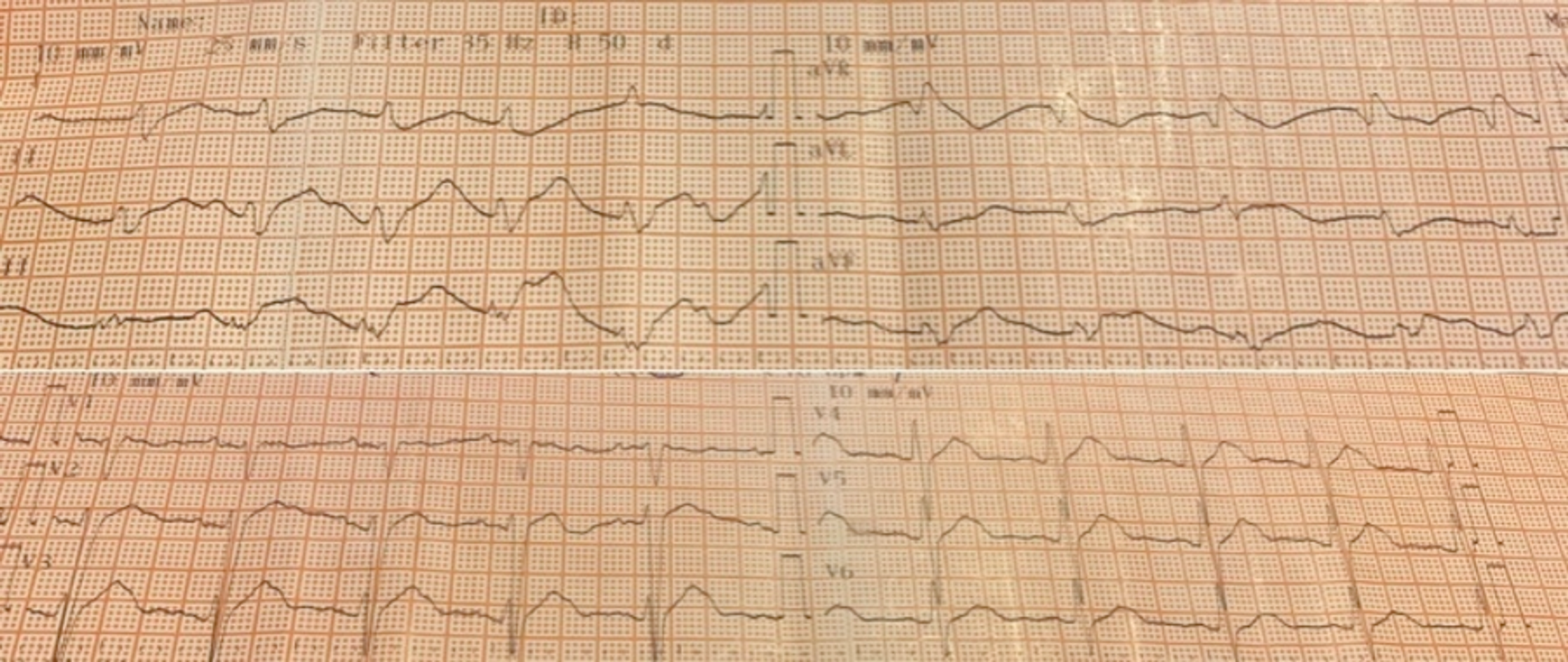 Propafenone Poisoning Of A Female Adolescent After A Suicide Attempt Cureus