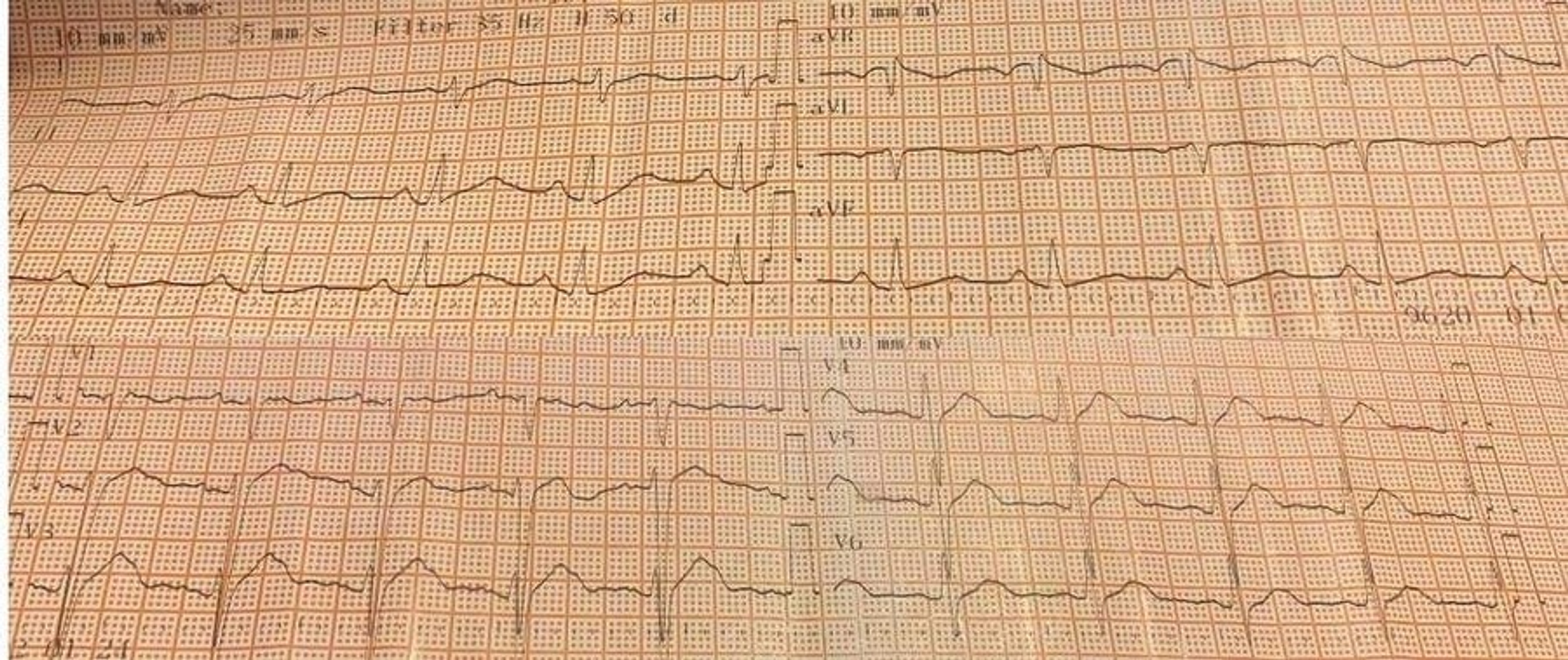 Cureus Propafenone Poisoning Of A Female Adolescent After A Suicide Attempt