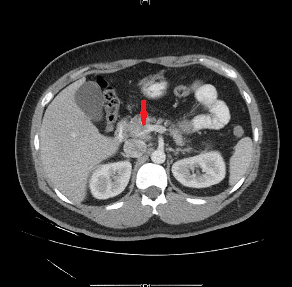 Cureus | Portal Vein Thrombosis Due to an Increase in Dose of ...