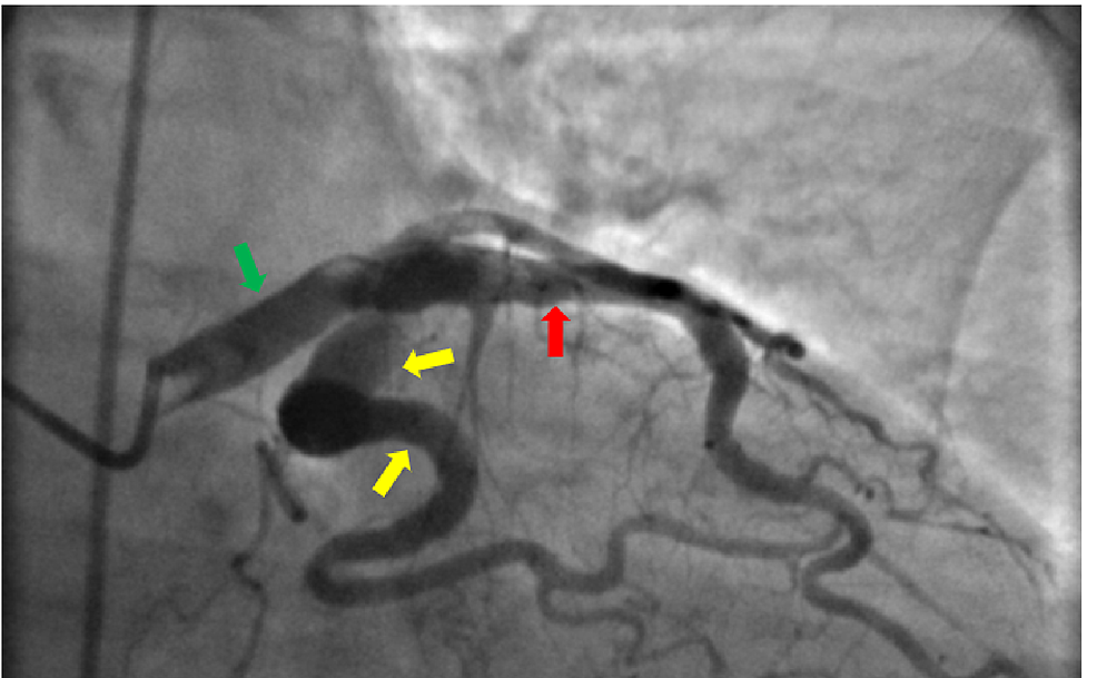 Coronary-angiographic-image-showing-severely-ectatic-segments-in-the-left-main-coronary-artery-(green-arrow),-left-anterior-descending-(LAD)-coronary-artery-(red-arrow)-and-proximal-and-middle-left-circumflex-coronary-artery-(yellow-arrows).