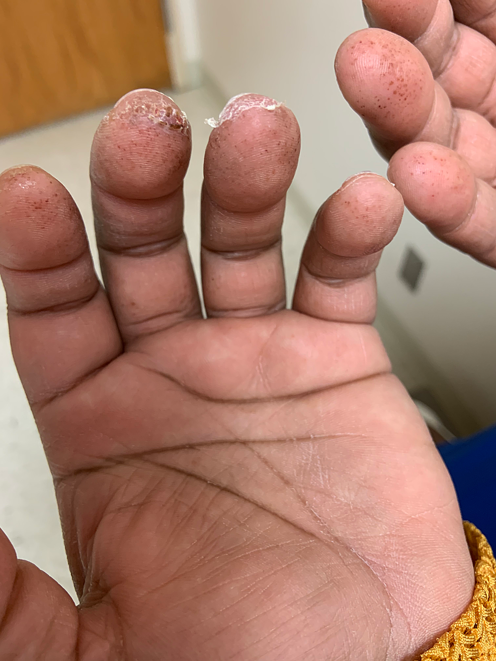 Petechiae-and-desquamation-of-patient's-fingers