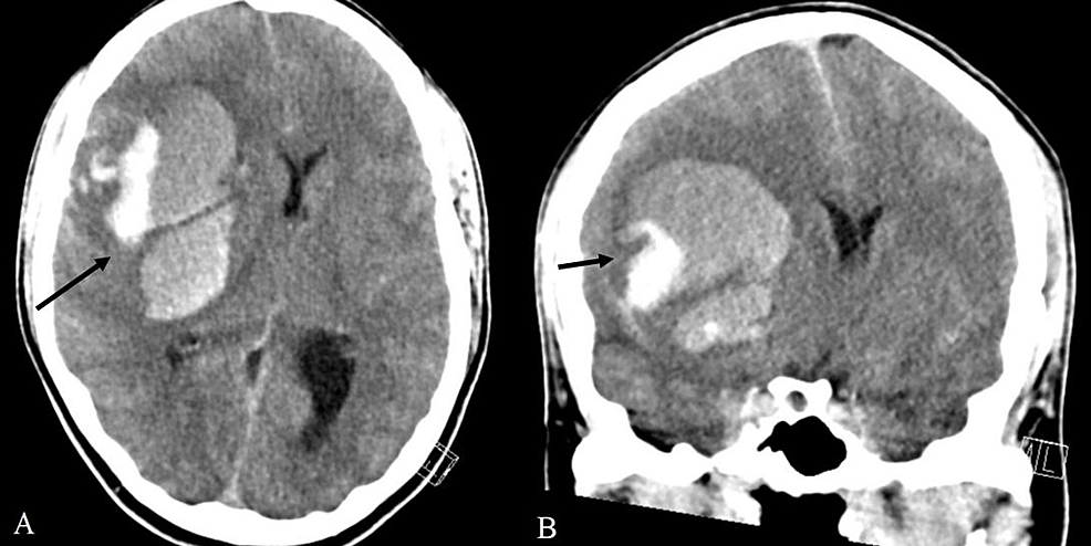 Head-CT-scan-performed-on-presentation-at-the-emergency-department-showing-a-large-intraparenchymal-hemorrhage-in-the-right-hemisphere.-(A)-Axial-plane-and-(B)-coronal-plane.