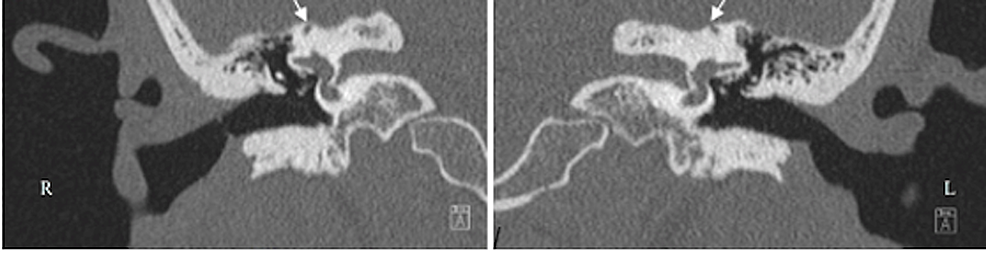 A-39-year-old-woman-presenting-with-many-auditory-and-vestibular-symptoms-including-hyperacusis,-tinnitus,-and-vertigo.-High-resolution-CT-scan-shows-thinning-of-the-(R)-right-and-(L)-left-osseous-roof-of-the-bilateral-semicircular-canals-with-possible-areas-of-dehiscence.