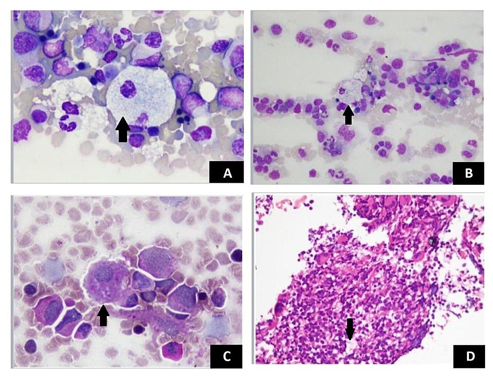 Niemann-Pick disease type-B: a unique case report with compound