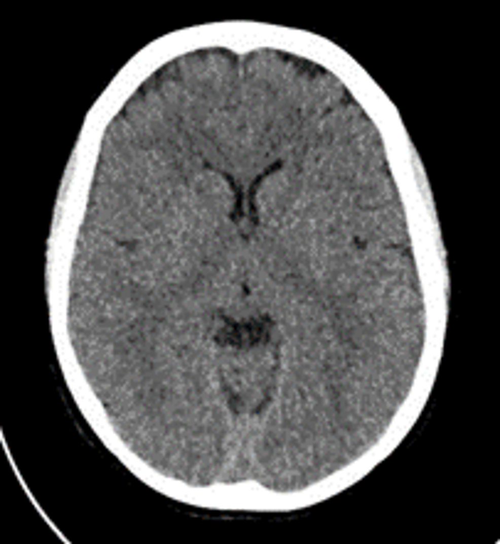 Sub-Dural Haematoma After Accidental Dural Puncture During Labour ...