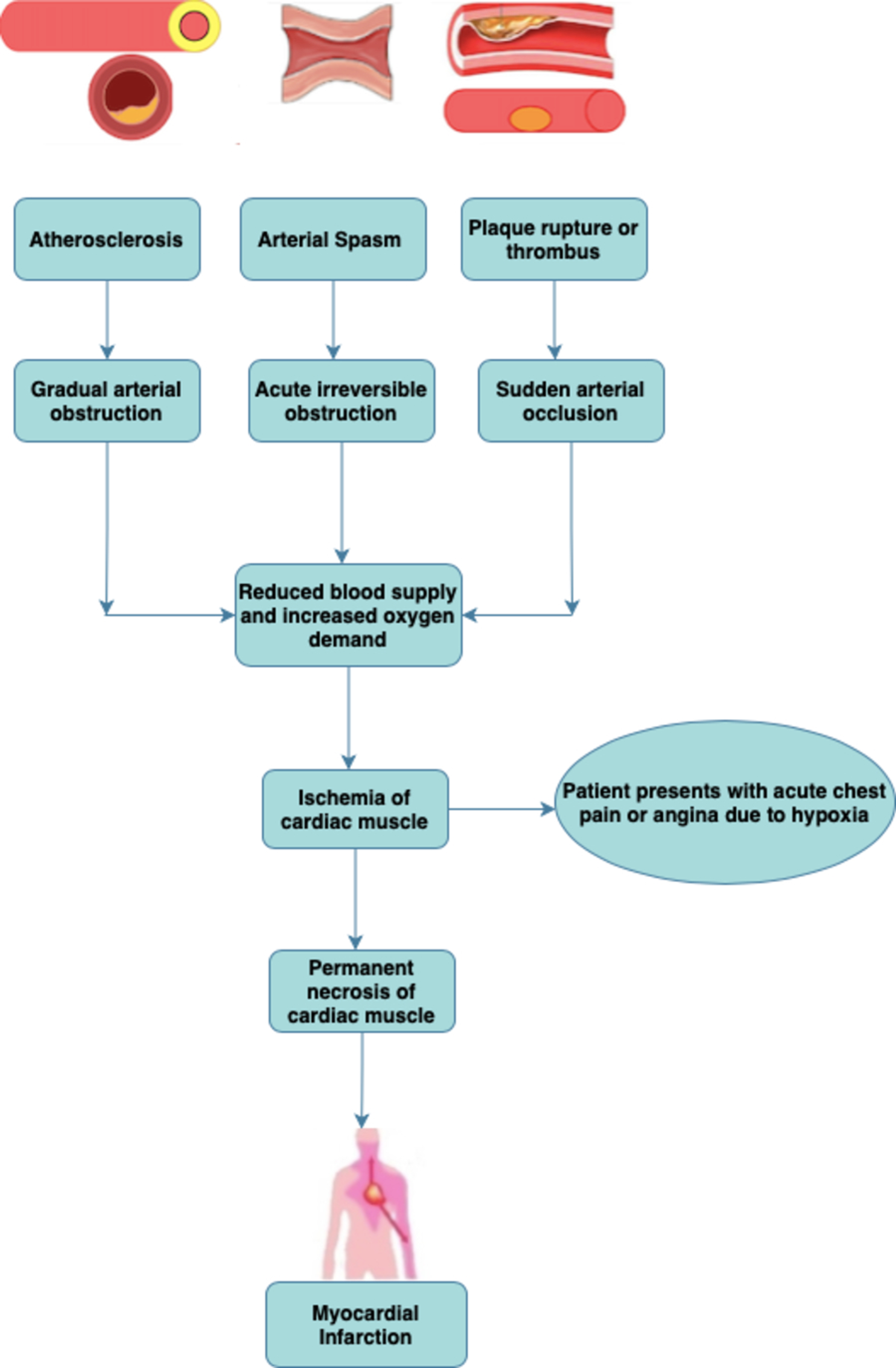 myocardial-infarction-mi