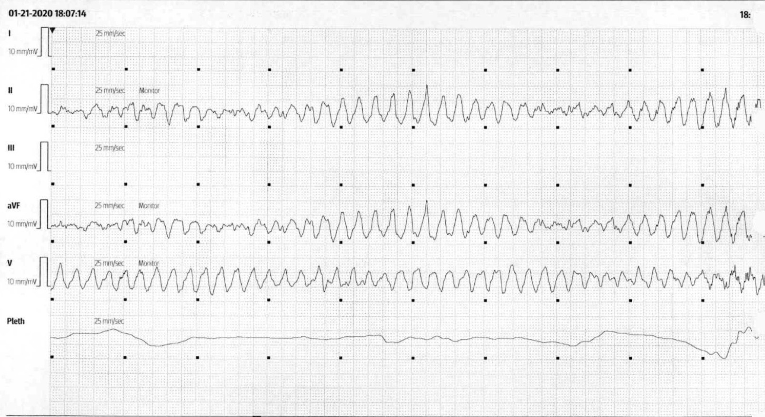 Cureus Torsades de Pointes With a Normal Magnesium Level in the