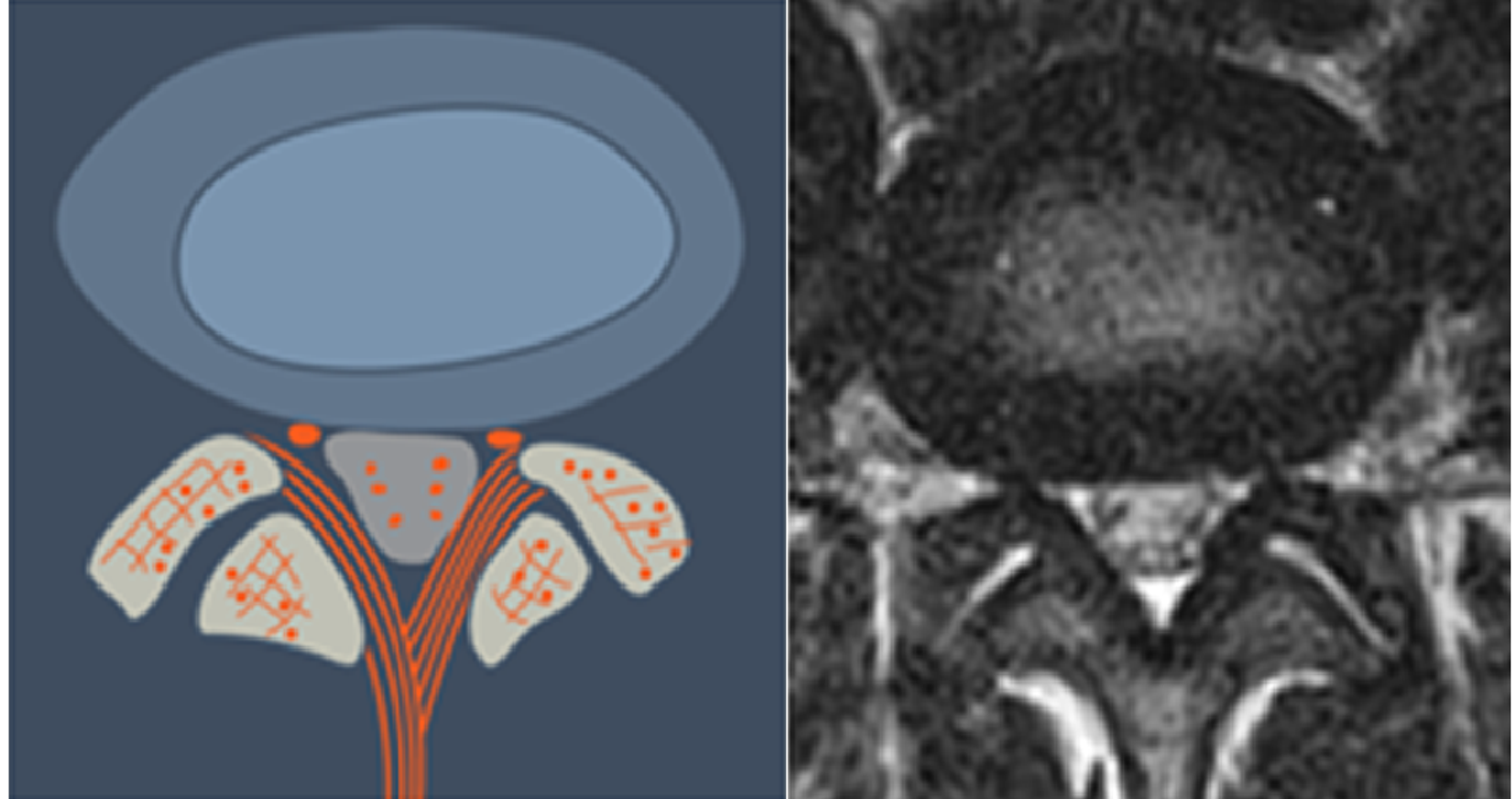 Cureus Anatomic ImageBased Classification of Lumbar Intervertebral