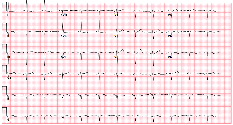 12-lead-electrocardiogram-shows-Q-waves-in-leads-II,-III,-aVF-and-inverted-T-waves-in-leads-V4-V6.