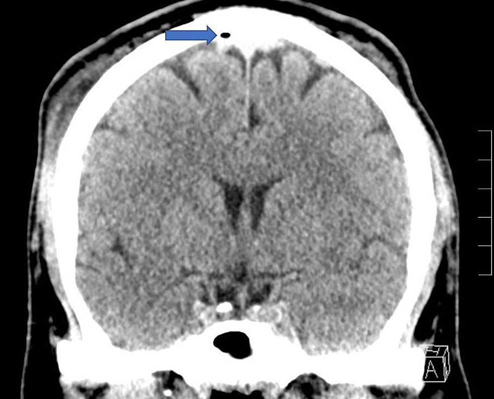 Traumatic Pneumocephalus Without Skull Fracture From a High-Voltage Electrical Injury