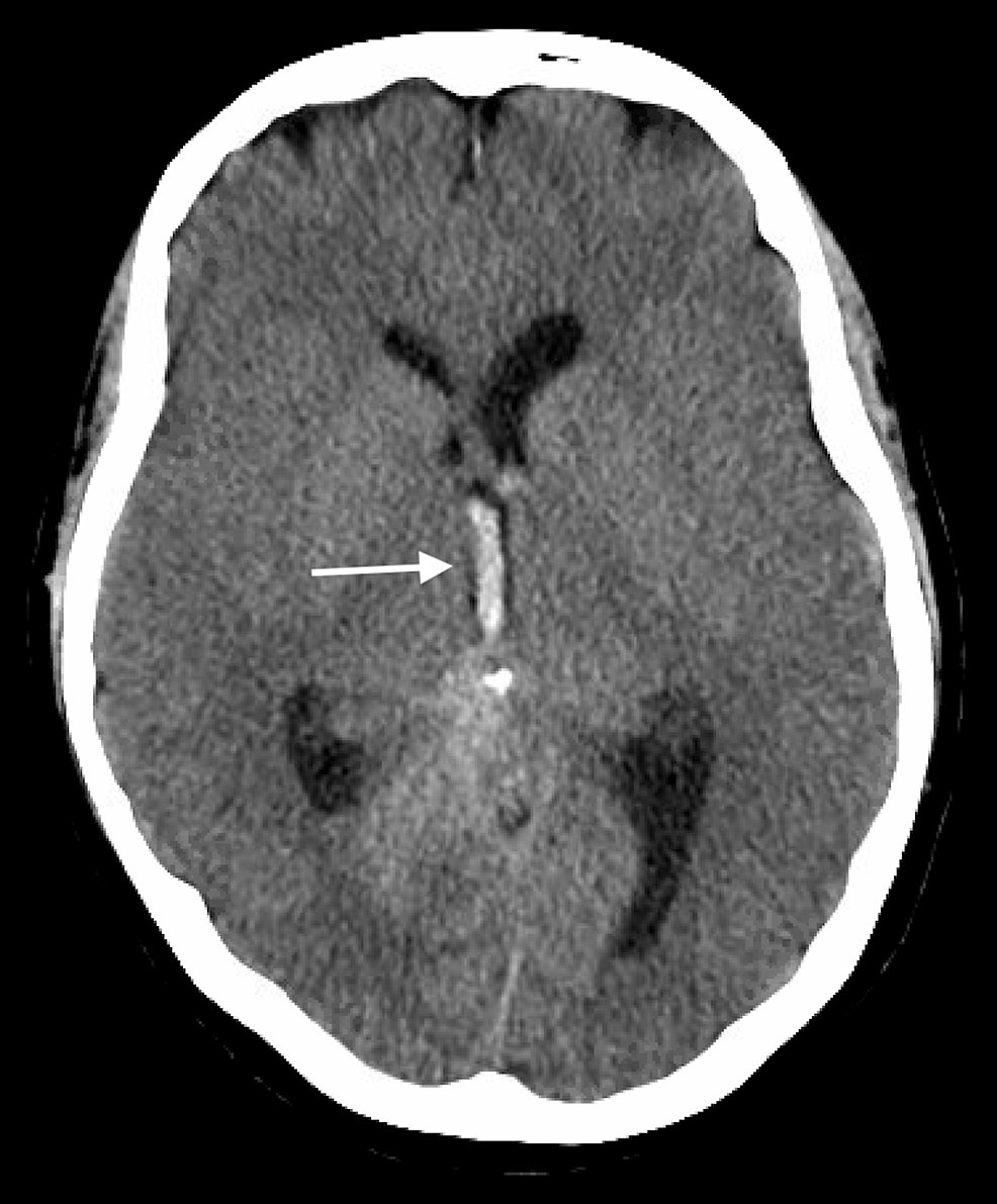 The subarachnoid hemorrhage (SAH) stages. The yellow arrows