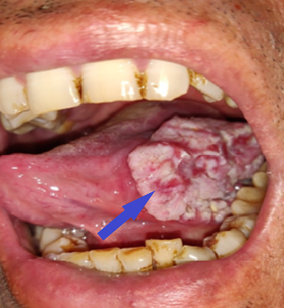 squamous cell carcinoma base of tongue