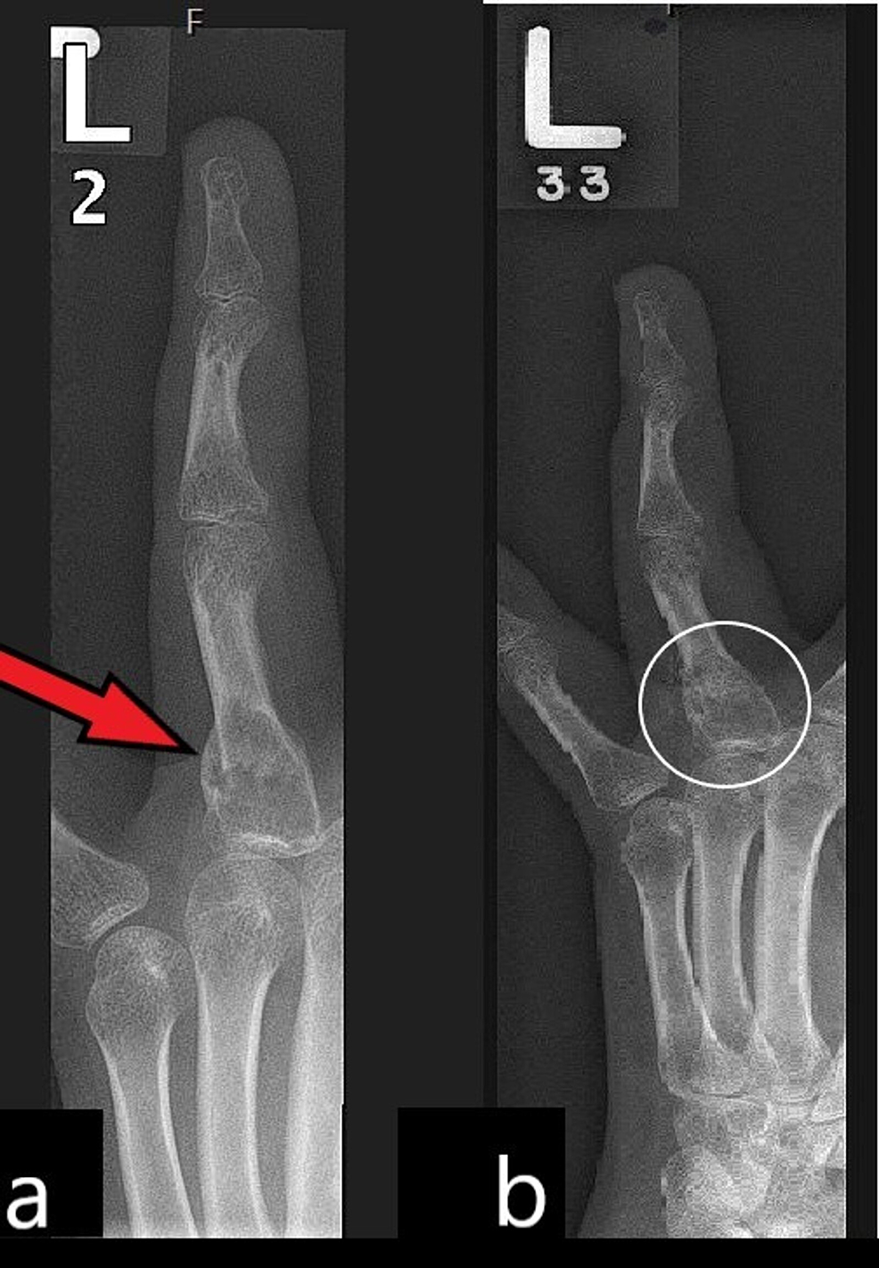 An Unusual Case of Finger Fracture Cureus